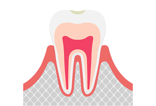 超初期のむし歯