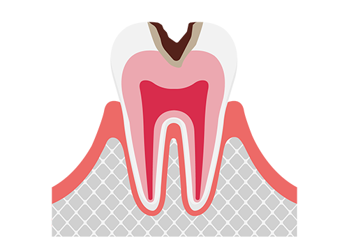 象牙質まで進行したむし歯