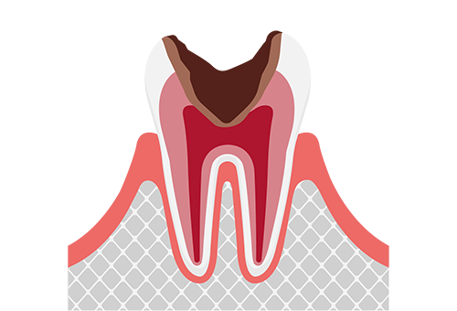 神経まで進行したむし歯