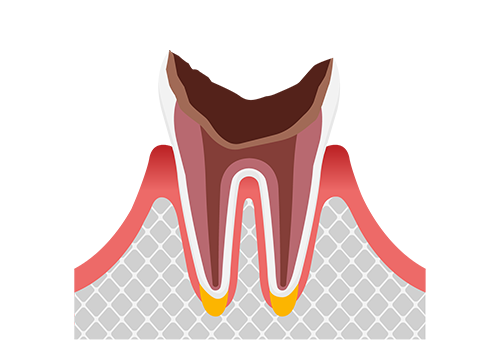 歯根だけ残ったむし歯