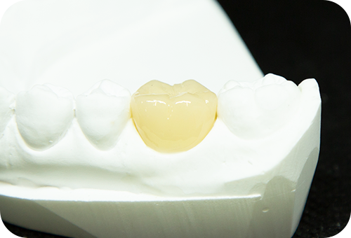 ハイブリッドセラミックの詰め物・被せ物