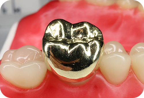 ゴールドの詰め物・被せ物