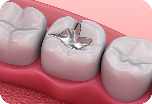 金属素材の詰め物・被せ物